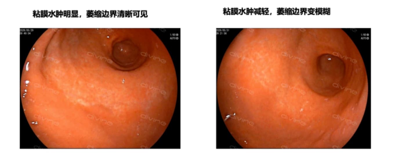 第二疗程：粘膜水肿明显减轻，萎缩边界由清晰变模糊，粘膜光泽度提升