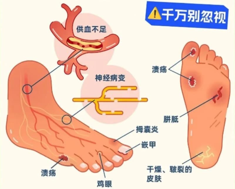 告别截肢噩梦！干细胞疗法为“无药可治”的重度糖尿病足按下暂停键