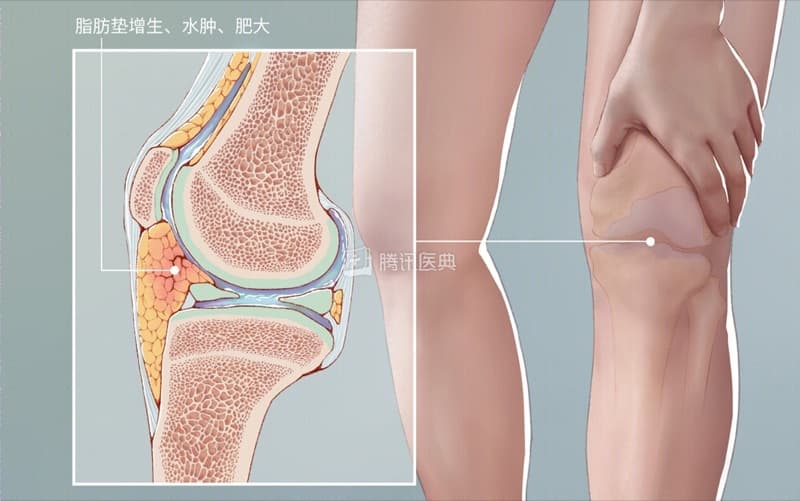 从“消炎”到“改环境”：干细胞为何能精准狙击脂肪垫炎？